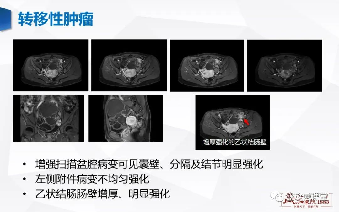 影像PPT - 【PPT】卵巢肿瘤-30