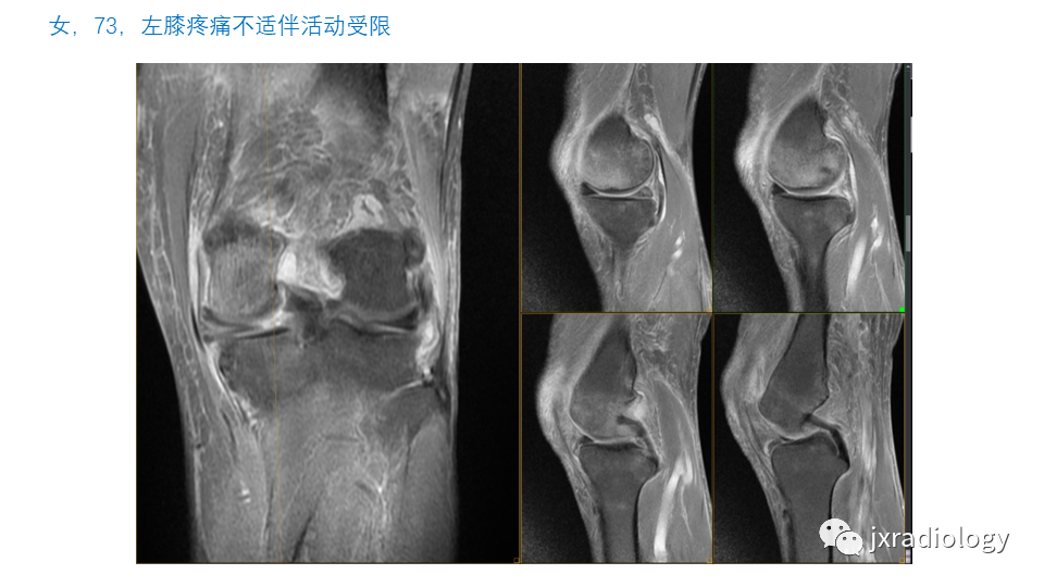 影像PPT - 【PPT】半月板根部撕裂-1