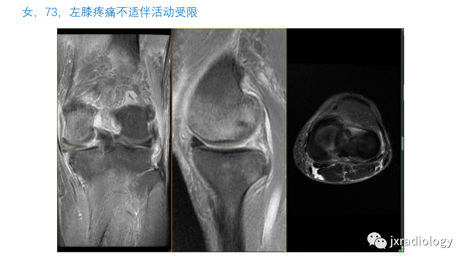 影像PPT - 【PPT】半月板根部撕裂-2