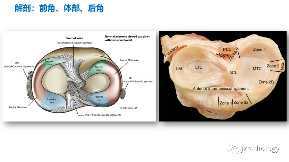 影像PPT - 【PPT】半月板根部撕裂-6