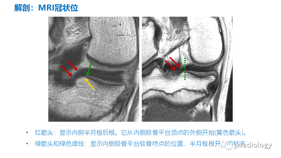 影像PPT - 【PPT】半月板根部撕裂-8