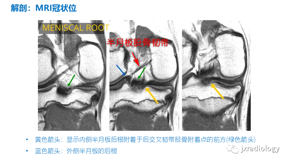 影像PPT - 【PPT】半月板根部撕裂-9