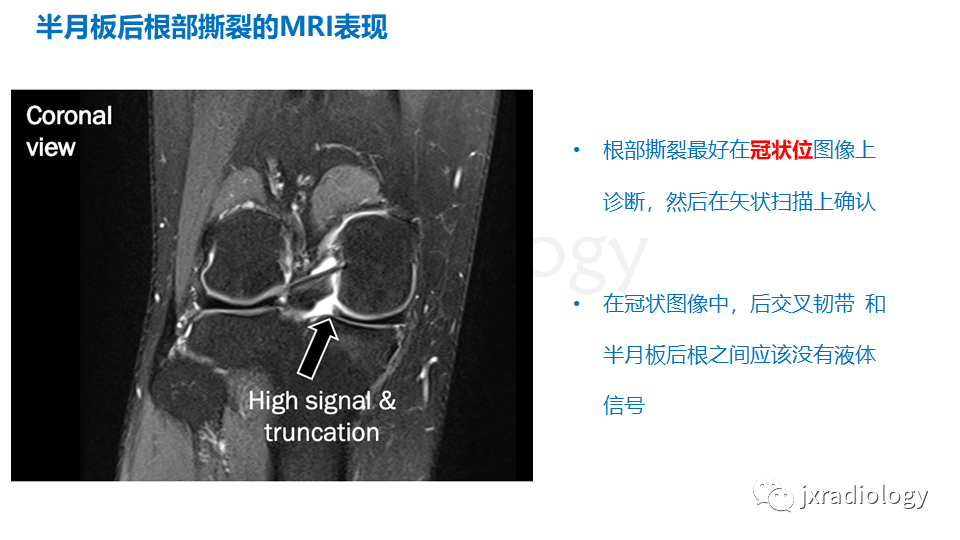 影像PPT - 【PPT】半月板根部撕裂-17