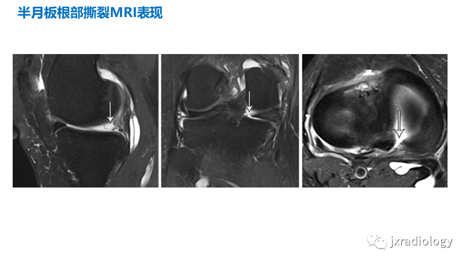 影像PPT - 【PPT】半月板根部撕裂-18