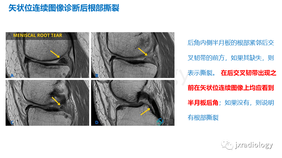 影像PPT - 【PPT】半月板根部撕裂-20