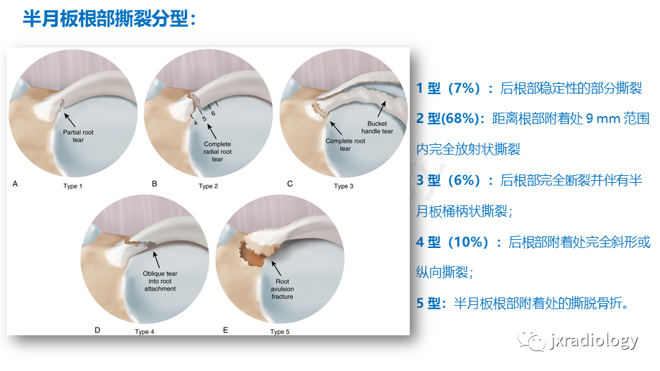 影像PPT - 【PPT】半月板根部撕裂-27
