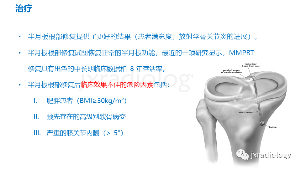 影像PPT - 【PPT】半月板根部撕裂-30