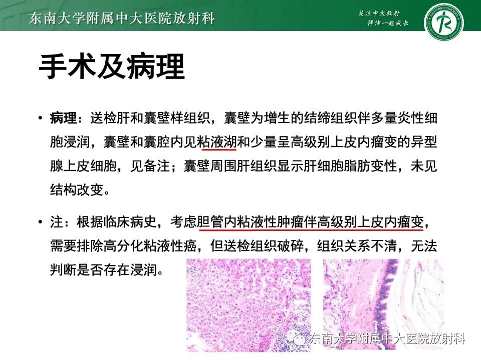 影像PPT - 【PPT】黏液性囊性肝胆肿瘤-5 影像PPT - 【PPT】黏液性囊性肝胆肿瘤-5