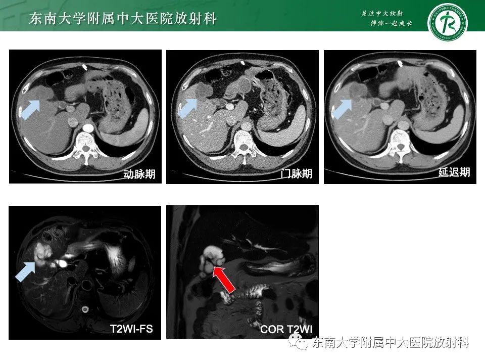 影像PPT - 【PPT】黏液性囊性肝胆肿瘤-6 影像PPT - 【PPT】黏液性囊性肝胆肿瘤-6