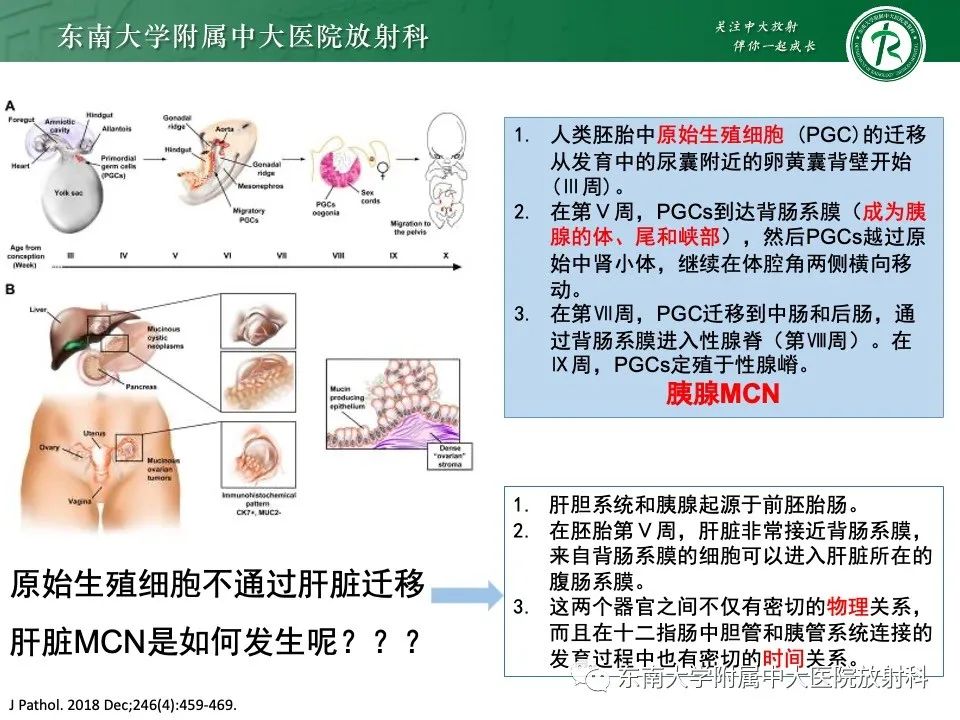 影像PPT - 【PPT】黏液性囊性肝胆肿瘤-11 影像PPT - 【PPT】黏液性囊性肝胆肿瘤-11