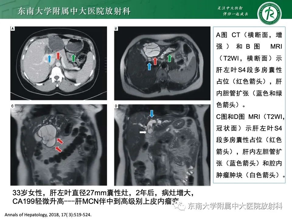 影像PPT - 【PPT】黏液性囊性肝胆肿瘤-16 影像PPT - 【PPT】黏液性囊性肝胆肿瘤-16