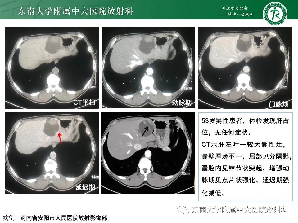 影像PPT - 【PPT】黏液性囊性肝胆肿瘤-23 影像PPT - 【PPT】黏液性囊性肝胆肿瘤-23