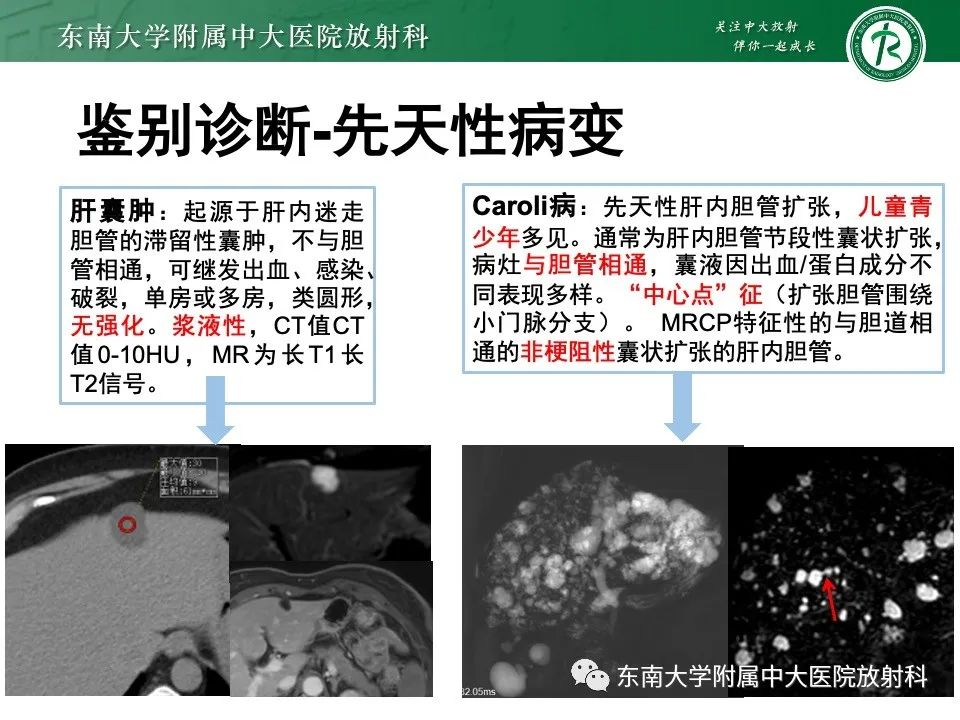 影像PPT - 【PPT】黏液性囊性肝胆肿瘤-27 影像PPT - 【PPT】黏液性囊性肝胆肿瘤-27