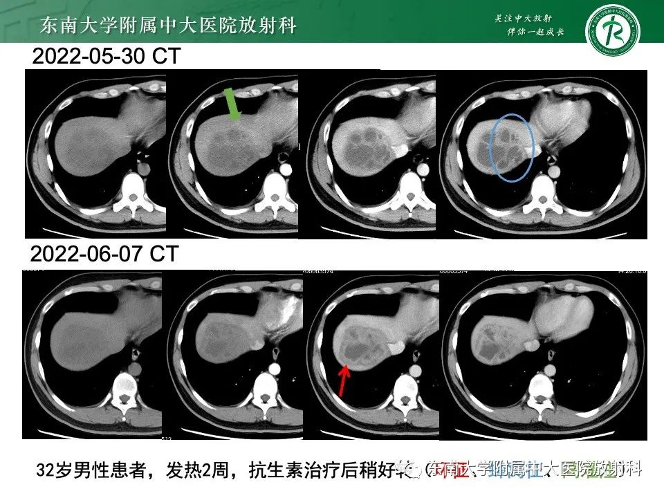 影像PPT - 【PPT】黏液性囊性肝胆肿瘤-31 影像PPT - 【PPT】黏液性囊性肝胆肿瘤-31