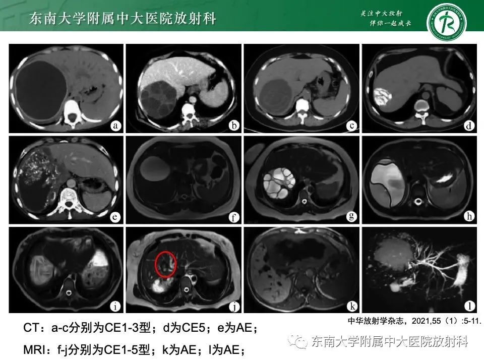 影像PPT - 【PPT】黏液性囊性肝胆肿瘤-36 影像PPT - 【PPT】黏液性囊性肝胆肿瘤-36