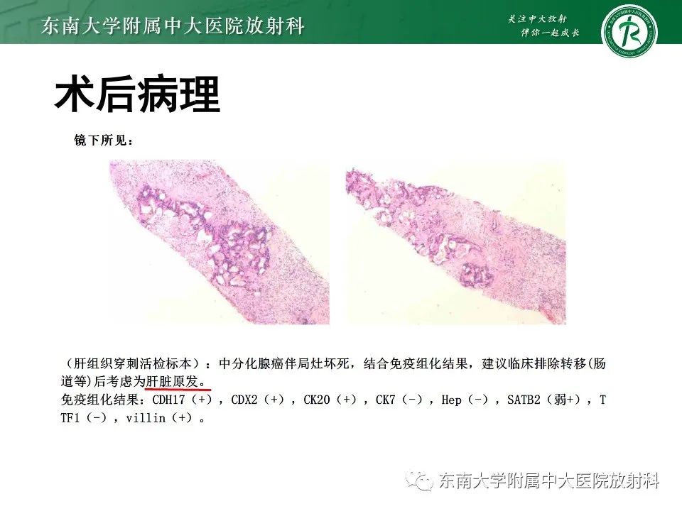 影像PPT - 【PPT】黏液性囊性肝胆肿瘤-38 影像PPT - 【PPT】黏液性囊性肝胆肿瘤-38