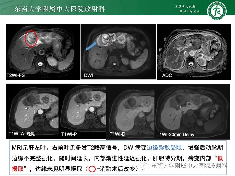 影像PPT - 【PPT】黏液性囊性肝胆肿瘤-41 影像PPT - 【PPT】黏液性囊性肝胆肿瘤-41