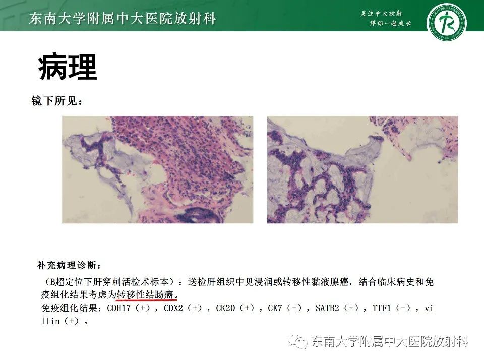 影像PPT - 【PPT】黏液性囊性肝胆肿瘤-43 影像PPT - 【PPT】黏液性囊性肝胆肿瘤-43