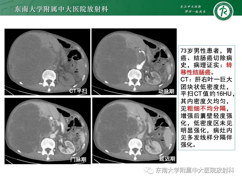 影像PPT - 【PPT】黏液性囊性肝胆肿瘤-46 影像PPT - 【PPT】黏液性囊性肝胆肿瘤-46