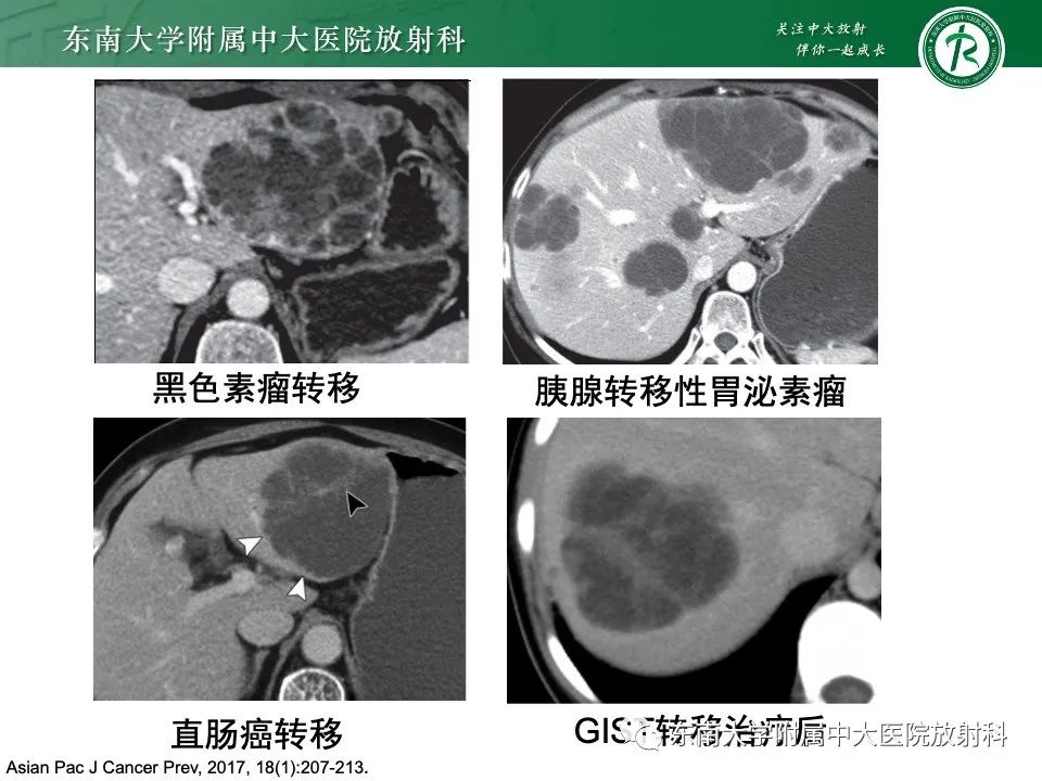 影像PPT - 【PPT】黏液性囊性肝胆肿瘤-47 影像PPT - 【PPT】黏液性囊性肝胆肿瘤-47