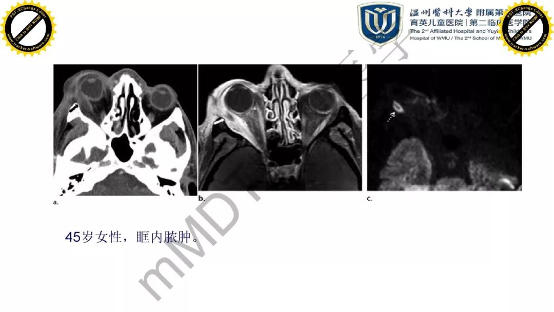 影像PPT - 【PPT】眼眶急诊的影像表现-10