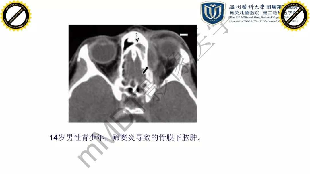 影像PPT - 【PPT】眼眶急诊的影像表现-11