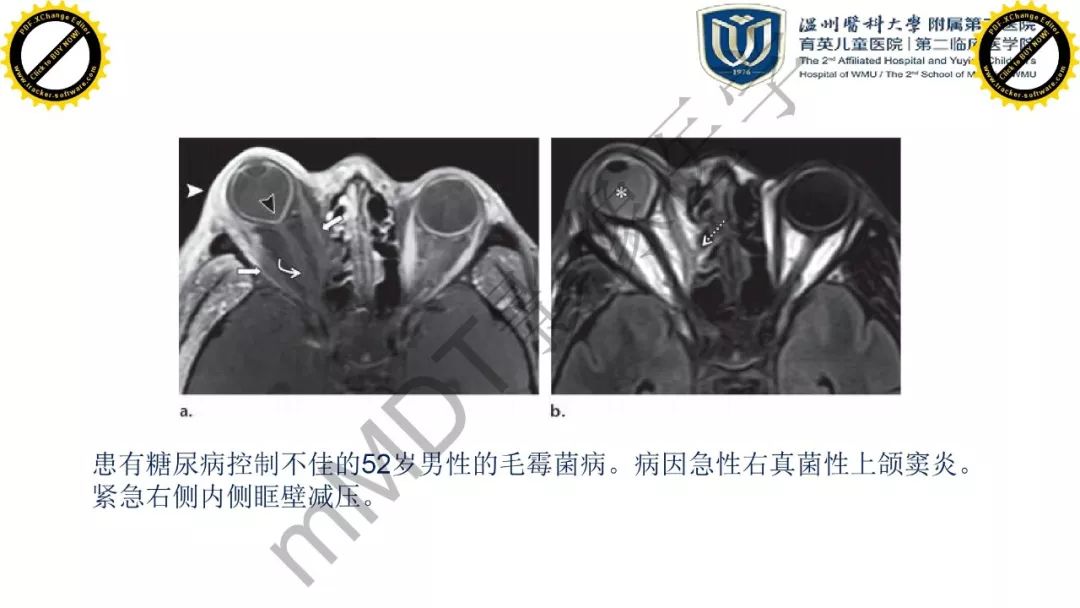 影像PPT - 【PPT】眼眶急诊的影像表现-13