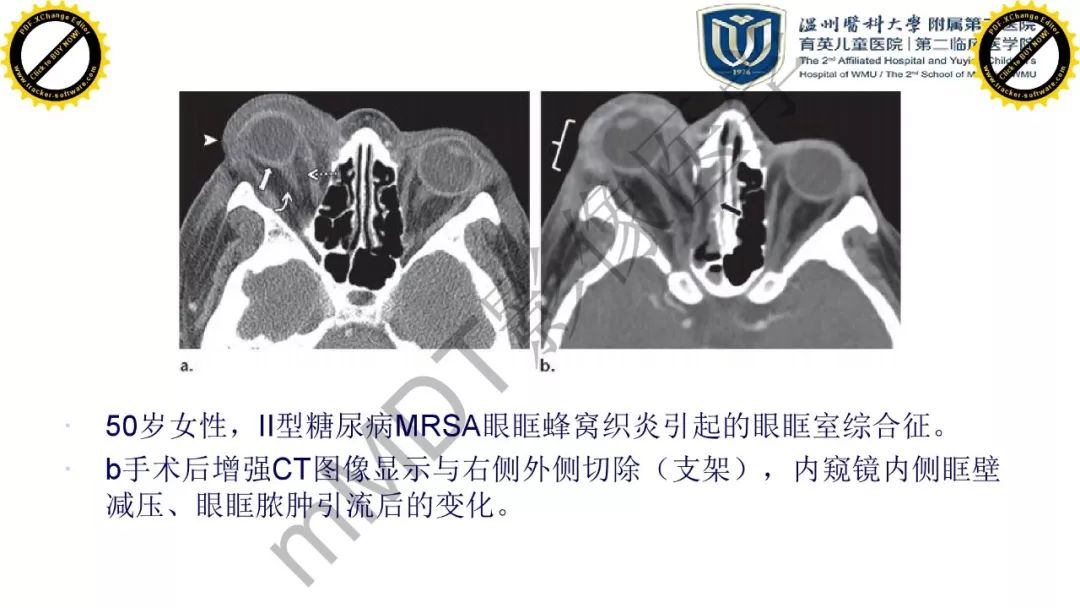 影像PPT - 【PPT】眼眶急诊的影像表现-17