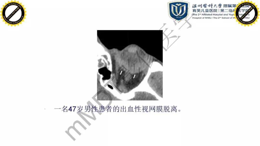 影像PPT - 【PPT】眼眶急诊的影像表现-20