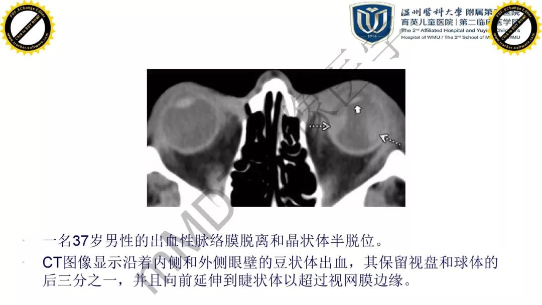 影像PPT - 【PPT】眼眶急诊的影像表现-21