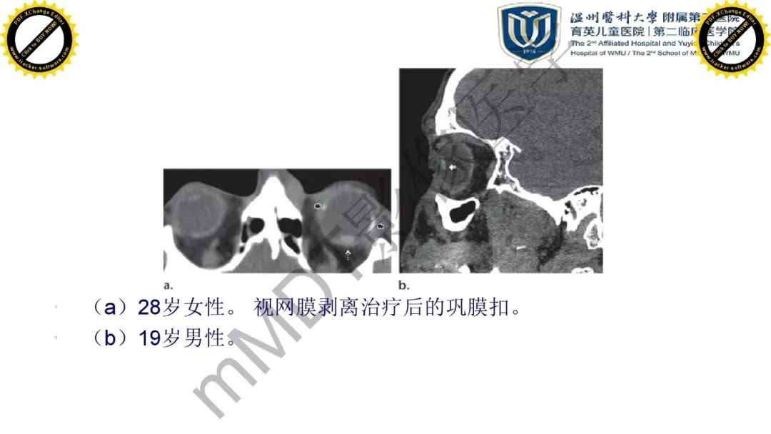 影像PPT - 【PPT】眼眶急诊的影像表现-25