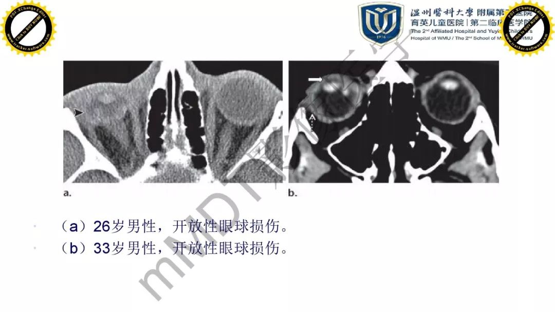 影像PPT - 【PPT】眼眶急诊的影像表现-23