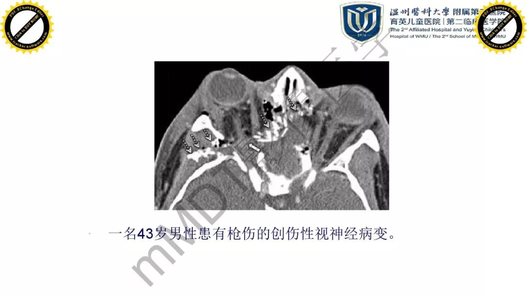 影像PPT - 【PPT】眼眶急诊的影像表现-29