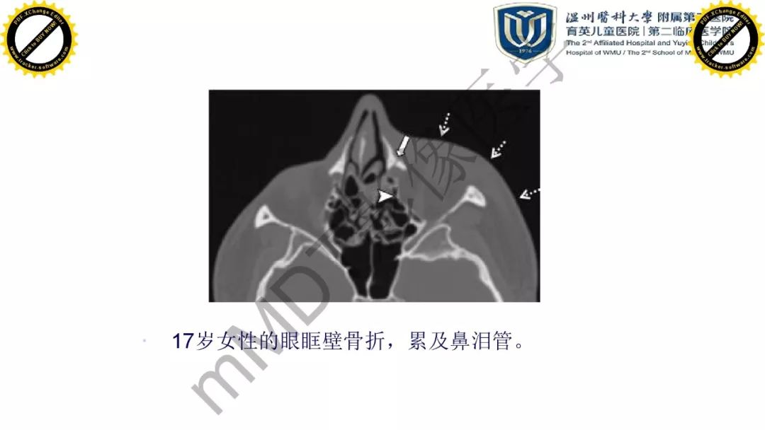 影像PPT - 【PPT】眼眶急诊的影像表现-31