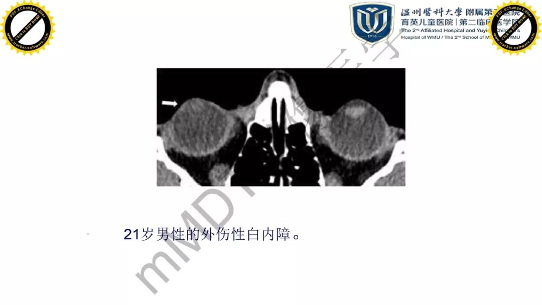 影像PPT - 【PPT】眼眶急诊的影像表现-27