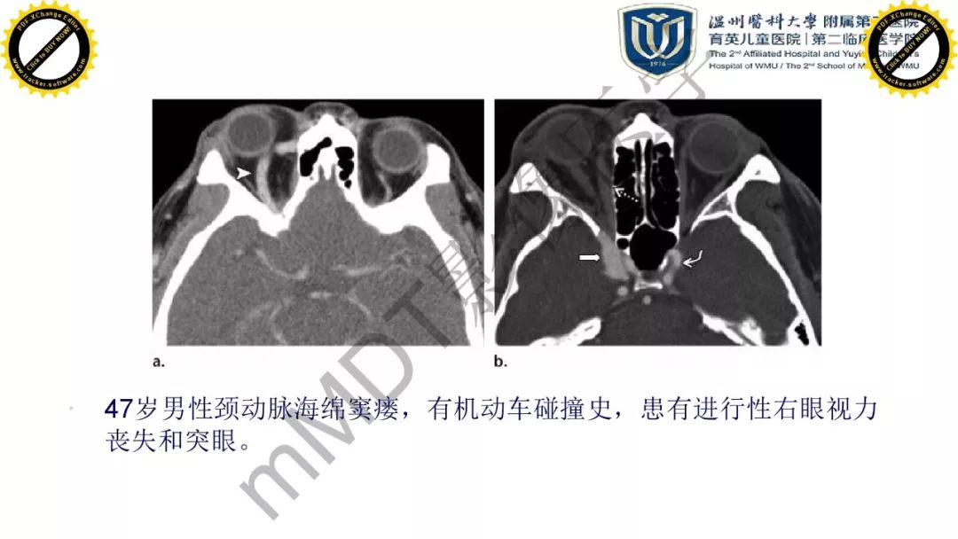 影像PPT - 【PPT】眼眶急诊的影像表现-34