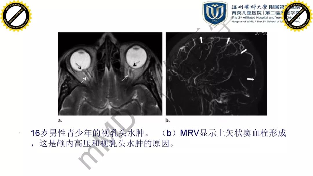 影像PPT - 【PPT】眼眶急诊的影像表现-38