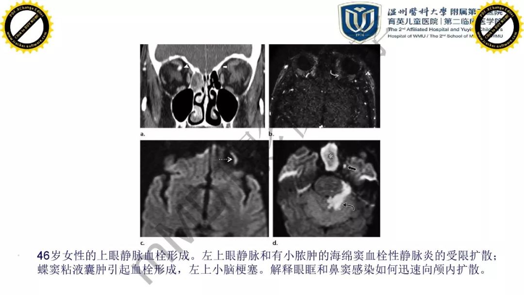影像PPT - 【PPT】眼眶急诊的影像表现-40