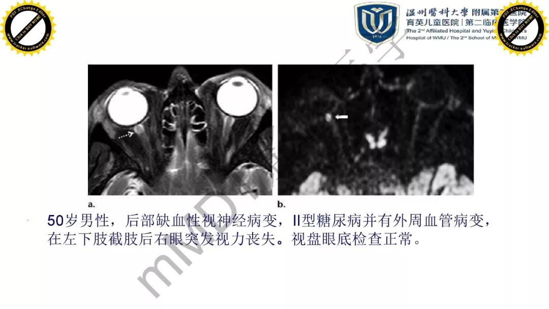 影像PPT - 【PPT】眼眶急诊的影像表现-36