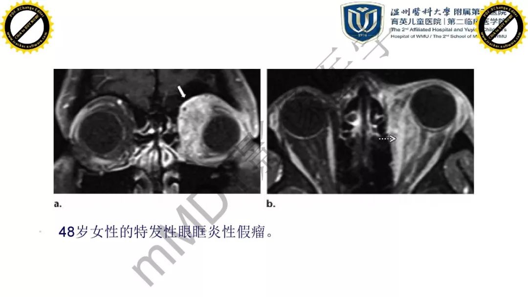 影像PPT - 【PPT】眼眶急诊的影像表现-43
