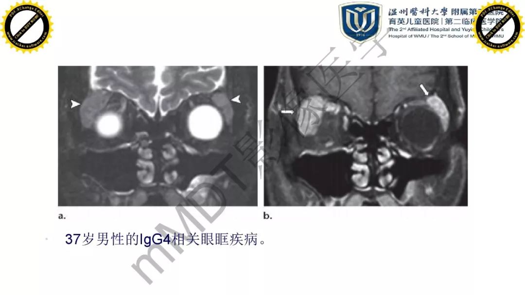 影像PPT - 【PPT】眼眶急诊的影像表现-44