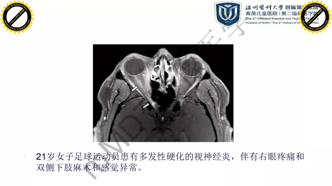 影像PPT - 【PPT】眼眶急诊的影像表现-46