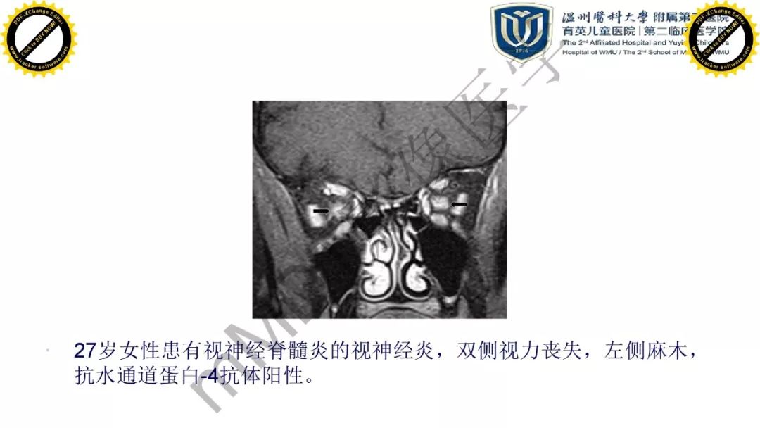 影像PPT - 【PPT】眼眶急诊的影像表现-47