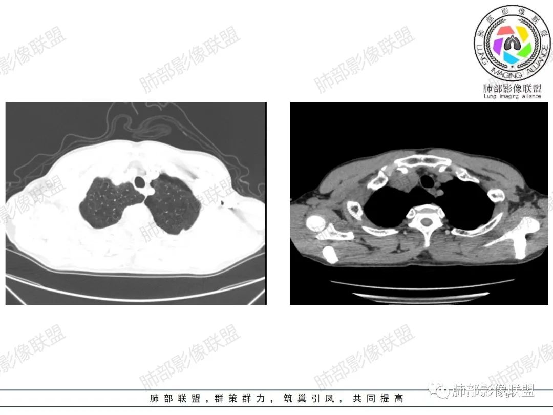 影像PPT - 【病例】纠结定位的恶性肿瘤-5 影像PPT - 【病例】纠结定位的恶性肿瘤-5