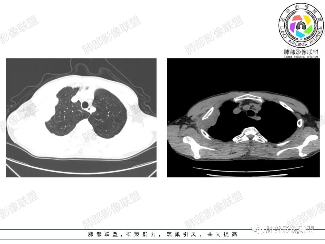 影像PPT - 【病例】纠结定位的恶性肿瘤-8 影像PPT - 【病例】纠结定位的恶性肿瘤-8
