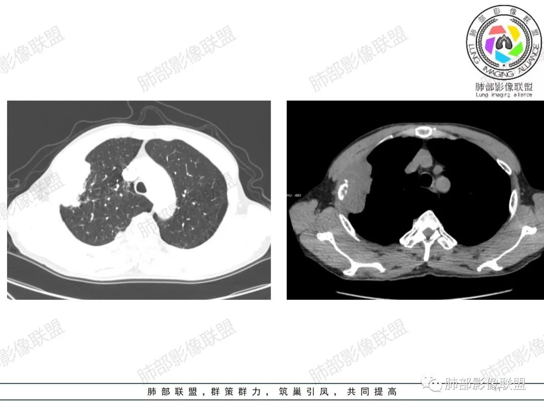 影像PPT - 【病例】纠结定位的恶性肿瘤-11 影像PPT - 【病例】纠结定位的恶性肿瘤-11