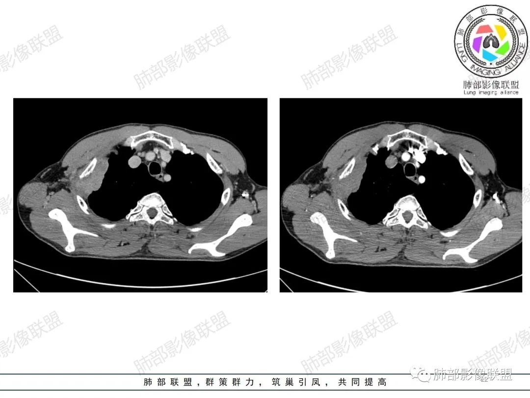影像PPT - 【病例】纠结定位的恶性肿瘤-22 影像PPT - 【病例】纠结定位的恶性肿瘤-22