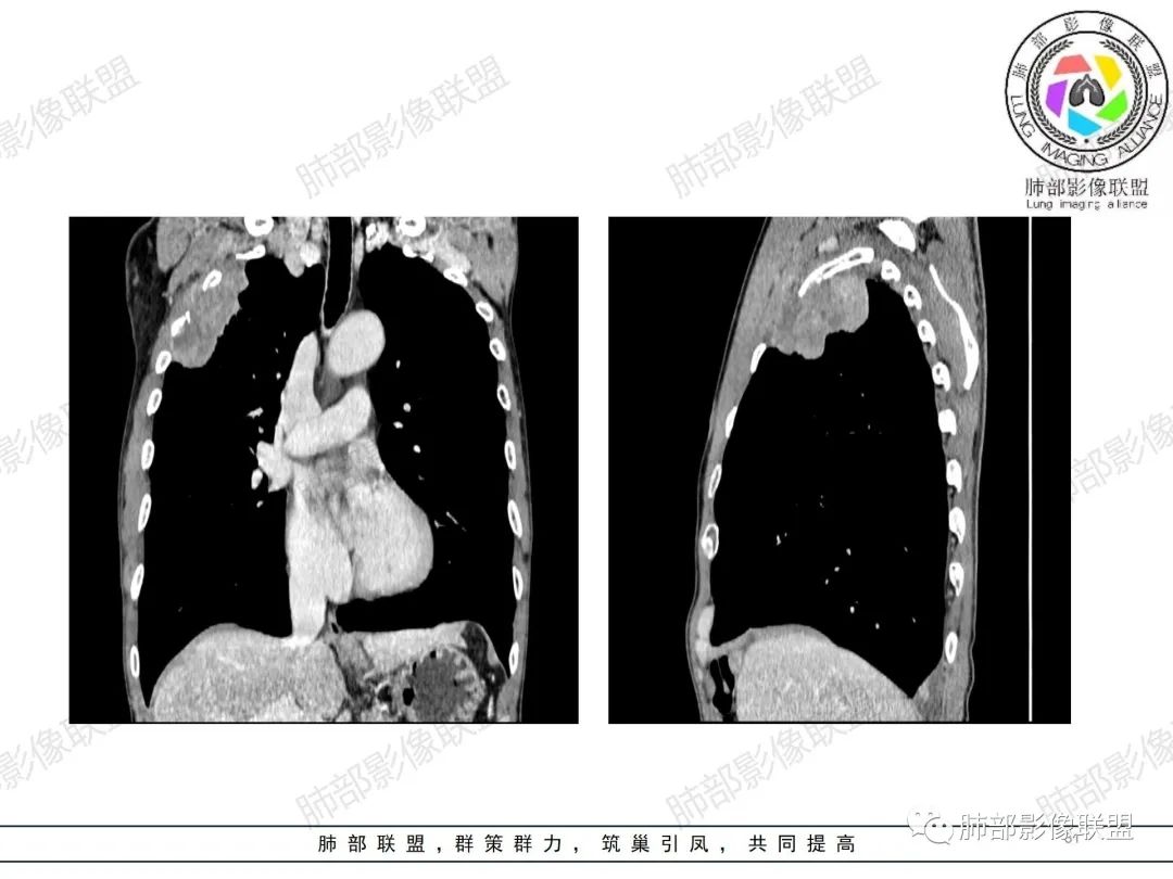 影像PPT - 【病例】纠结定位的恶性肿瘤-31 影像PPT - 【病例】纠结定位的恶性肿瘤-31