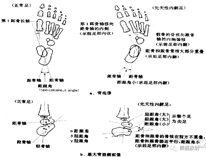 影像PPT - 【病例】先天性马蹄内翻足1例X线-5 影像PPT - 【病例】先天性马蹄内翻足1例X线-5
