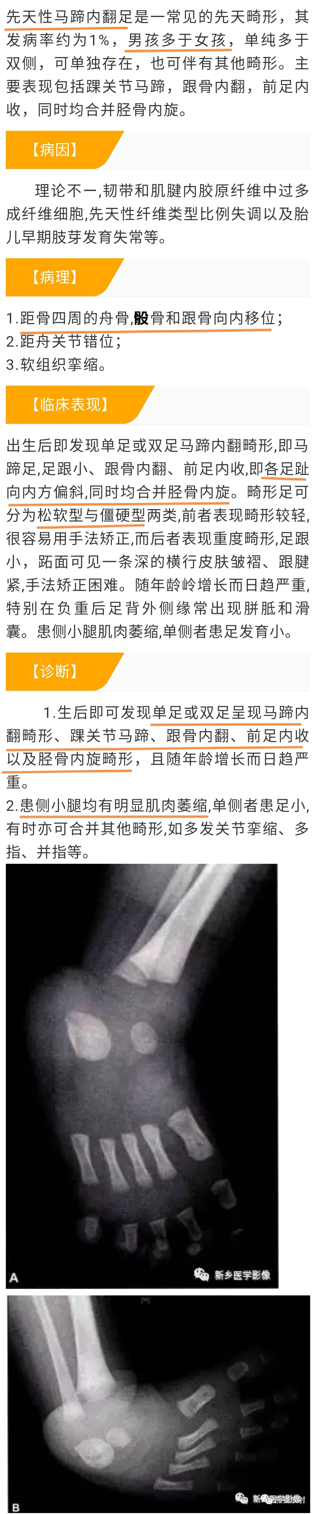影像PPT - 【病例】先天性马蹄内翻足1例X线-7 影像PPT - 【病例】先天性马蹄内翻足1例X线-7